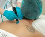 Effective Methods for Removing Tattoos